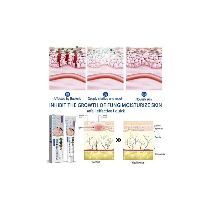 //arx Crema Antimicótica Para La Tiña Inguinal