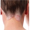 Psoriasis Control Shampoo