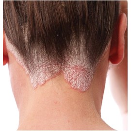 Psoriasis Control Shampoo