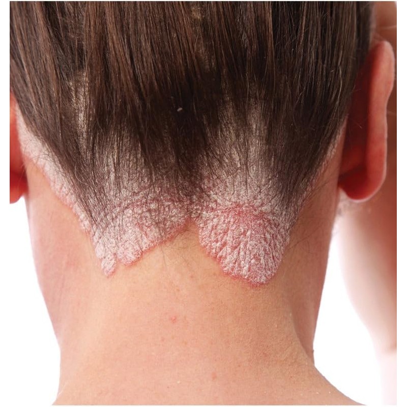 Psoriasis Control Shampoo