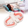 Dental Disease Caries Teeth Model Resin Simulation Teaching Prop Dental