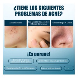 Crema De Anti Acne Reducir El Acné Rojizo 20g