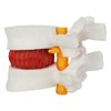 Axis Scientific Human Lumbar Herniating Disc Demonstration Anatomy Model for