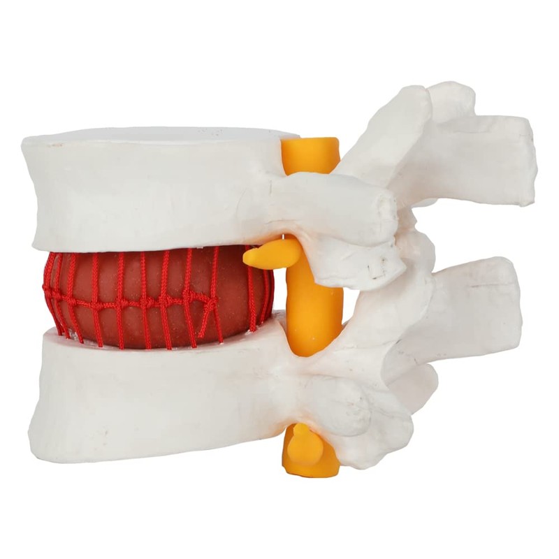 Axis Scientific Human Lumbar Herniating Disc Demonstration Anatomy Model for