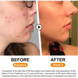 Vitamin C Face Serum 20%, Hyaluronic Acid, Alpha Arbutin and Vitamin E, Anti Aging for Dark Spots, Wrinkles & Acne, Brightens Skin Tone, Restores Radiance, 1 fl.oz. 30ml