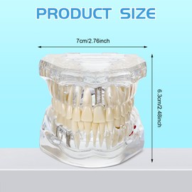 Outus Disease Teeth Model Dental Implant Teeth Model with Removable Tooth Dentist Standard Tooth Pathological Demonstration for Christmas Education Dental Supplies(Transparent,2 Pcs)
