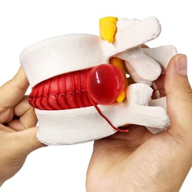 Human Herniated Disc Model, Anatomical Herniated Lumbar Vertebrae Disc Prolapse Model for Medical Teaching & Education Kids Learning Education Display Tool