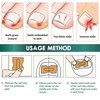 100PCS Ingrown Toenail Correction Patches, for Ingrown Toenail Treatment, Effective