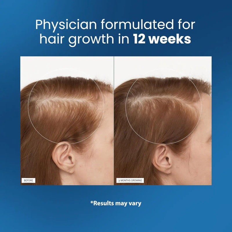 Esencia Enrollable De Romero Para El Crecimiento Del Cabello