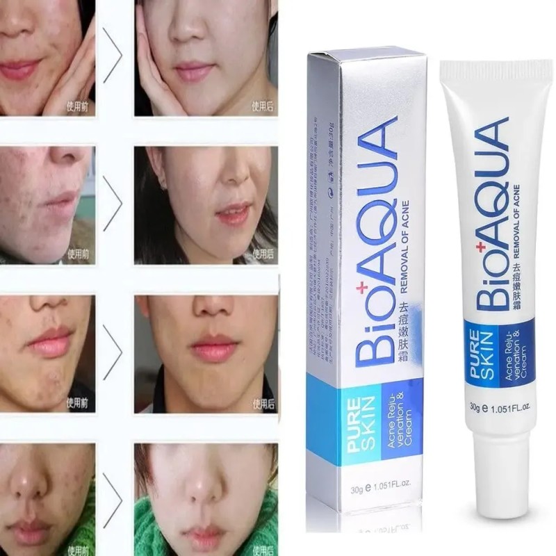 Bioaqua Acne Cream reduce cicatrices, poros y grasa, cuidado continuo
