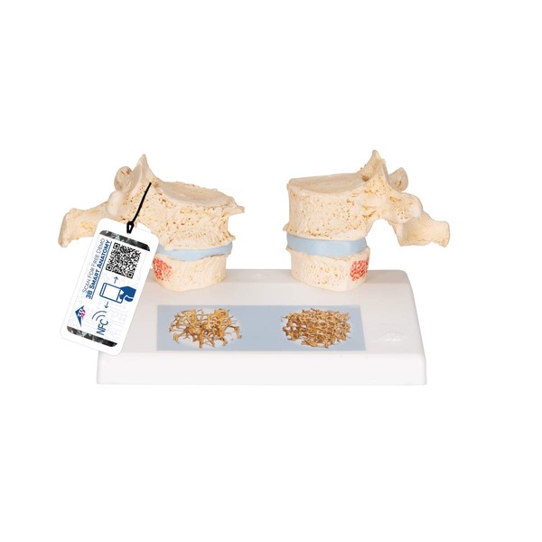 3B Scientific Human Anatomy - Osteoporosis Model + Free Anatomy