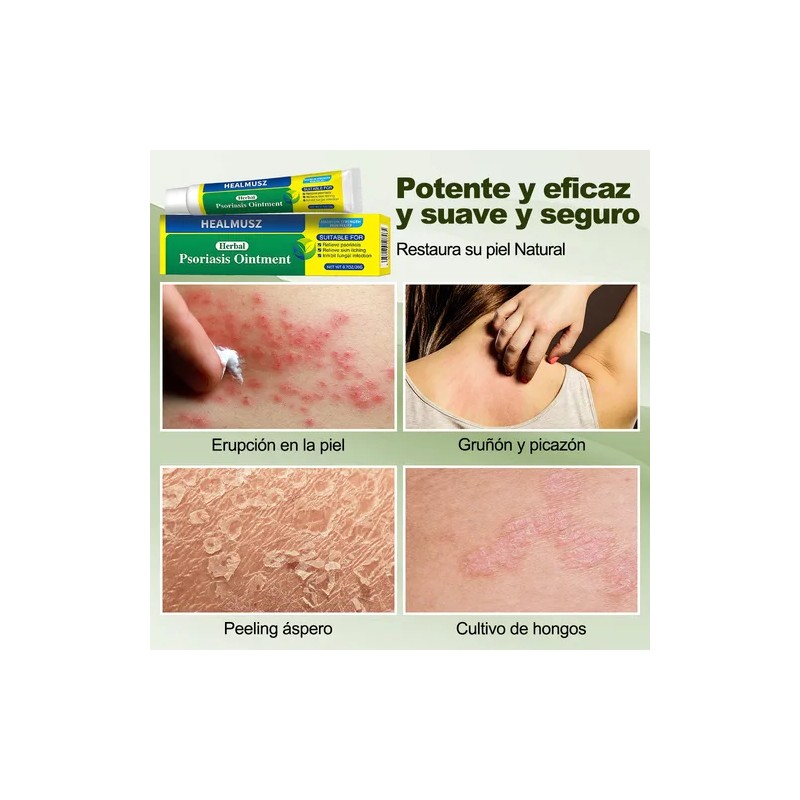 Crema De Psoriasis Para Varios Síntomas De Psoriasis 20g