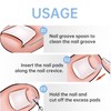 Toenail Correction, Ingrown Toenail Correction Set, 40 Pieces Painless Toenail