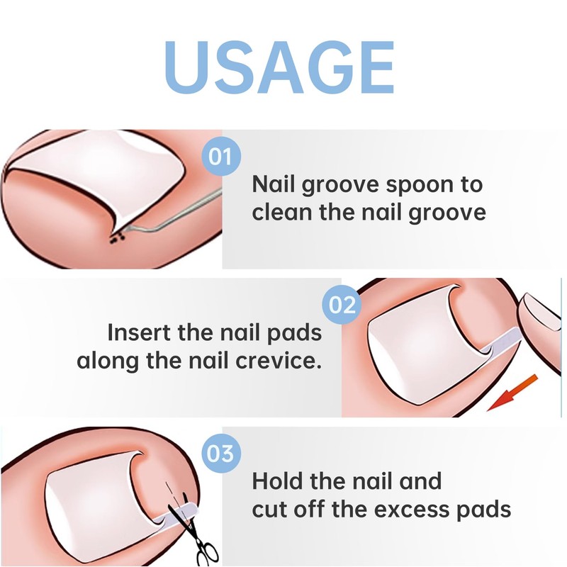 Toenail Correction, Ingrown Toenail Correction Set, 40 Pieces Painless Toenail