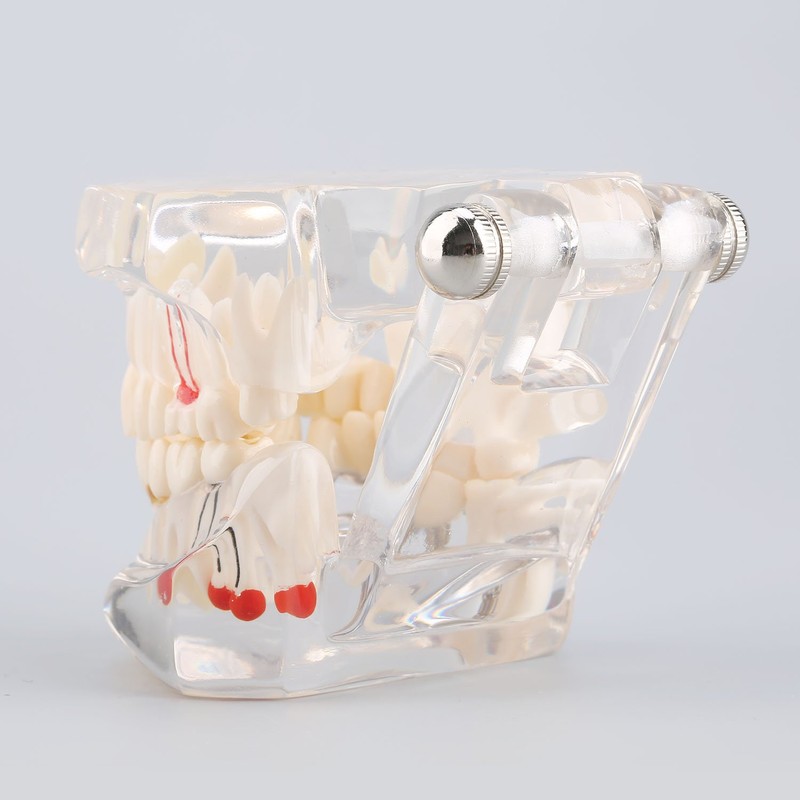 Detachable Dental Model Dental Disease Teaching Study Typodont Demonstration Tooth