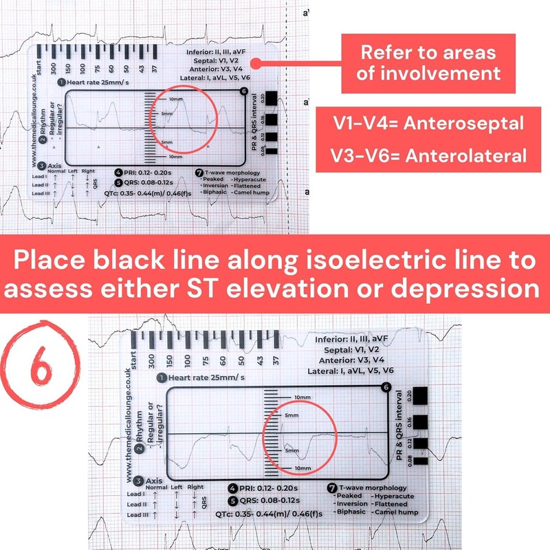 Yeanifeana ECG 7 regla de pasos, ECG 7 regla de