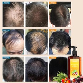 Batana Rosemary Onion Shampoo Hair Growth, Reducir Pérdida Cabello, Aceite Batana, Romero, Extracto Cebolla Mantenimiento Cabello Duradero, Reparar Cabello Dañado