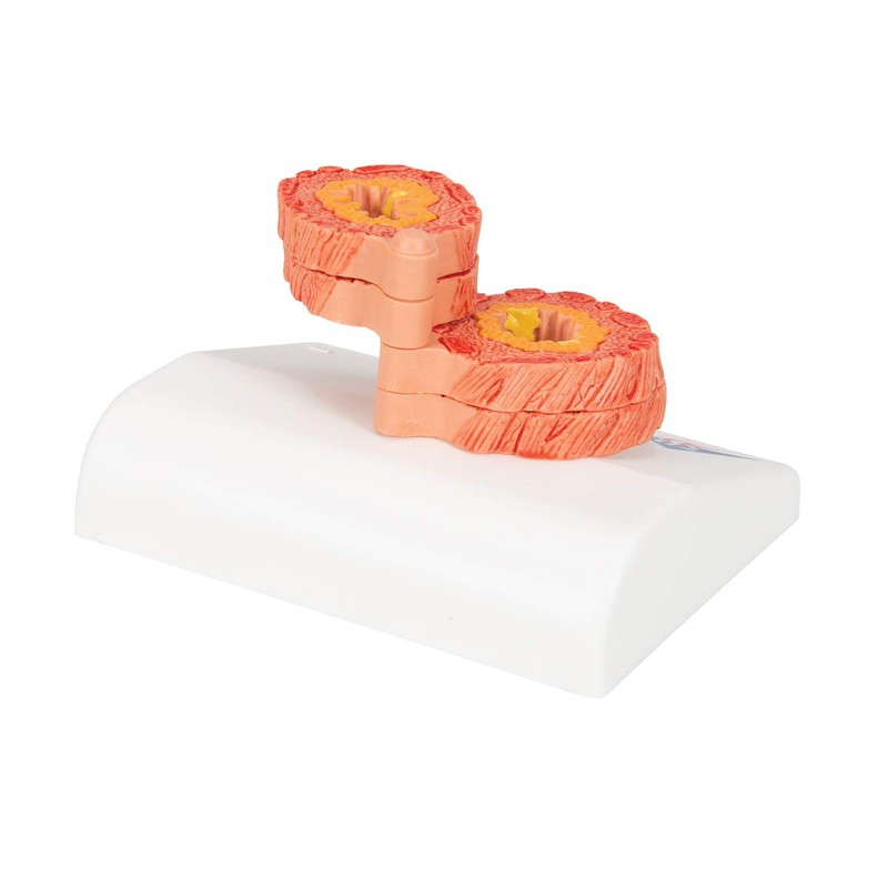 3B Scientific Human Anatomy - COPD Model + Free Anatomy