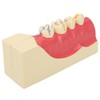 Right Lower Posterior Tooth Model 2X Magnification Detachable Resin Tooth