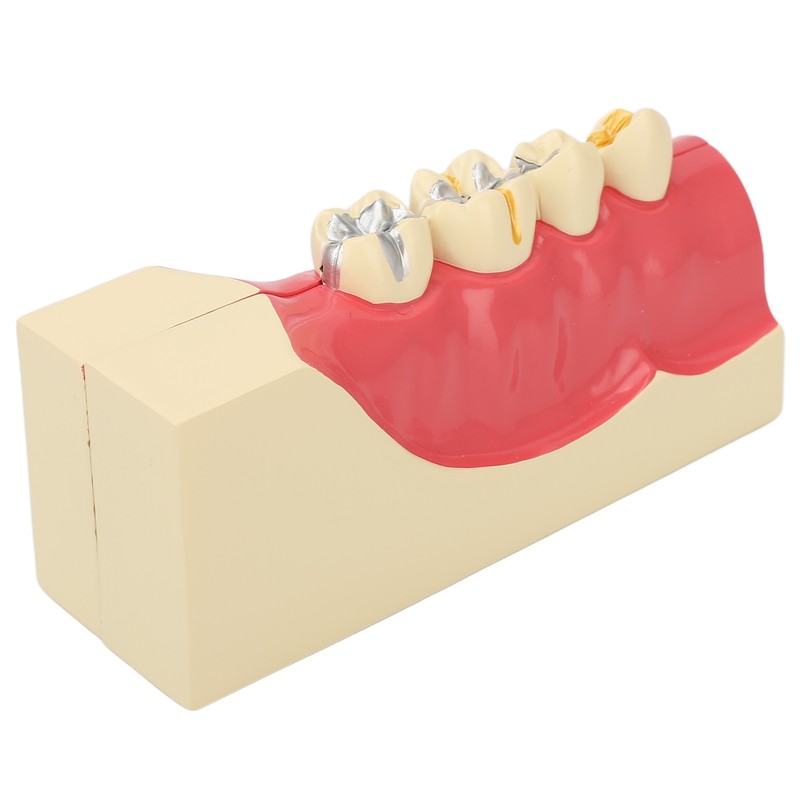 Right Lower Posterior Tooth Model 2X Magnification Detachable Resin Tooth