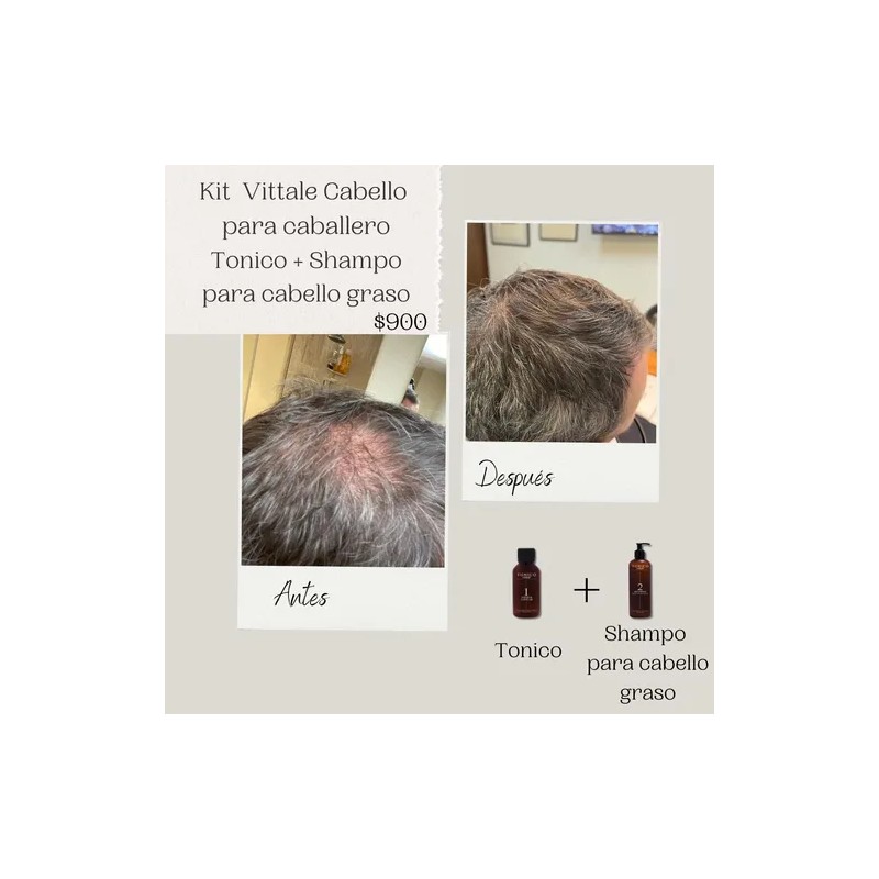 Paquete Tónico Y Shampoo Para Cabello Graso Tónico Vittale