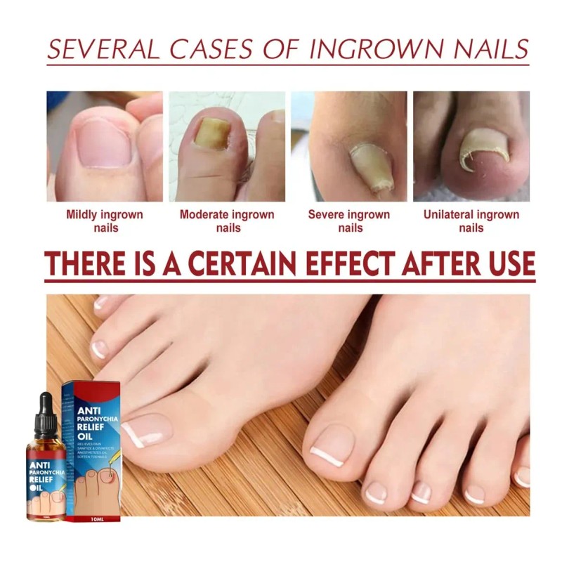 Cepillo De Abejas Generic Zanaquick Antihongos Uñas