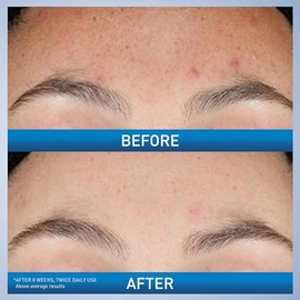 CeraVe Suero de Retinol Renovador para Marcas Post-Acné, Formulado con Extracto de Raíz de Regaliz y Niacinamida, Suero Iluminador y Minimizador de Po