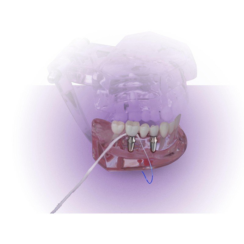 Thornton Super Floss Bridge Implant Type, 30 Pieces x 12