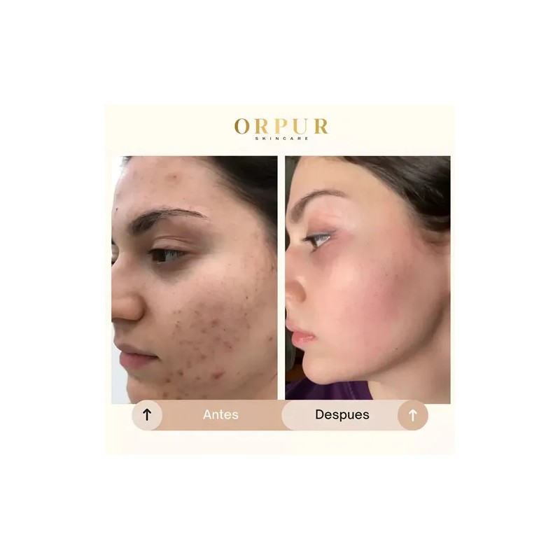 Crema Facial Hidratante Dermoaclaradora Anti Acne 4 Pack Todo Tipo