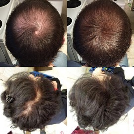 Nor1 Keratin Hair Building Fibers: Hair Fiber Filler and Thickener for Men and Women - Cover Up and Concealer for Thinning Areas or Minor Bald Spot - Thicker, Fuller Hair in Seconds - 25 grams