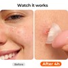 TKTK Pimple Patches for Face, 0.01cm Ultra-Thin Invisible Acne Patches,