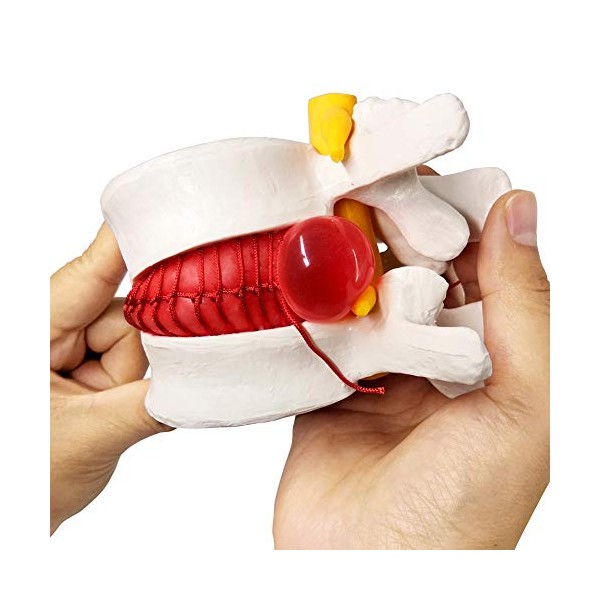 Human Herniated Disc Model, Anatomical Herniated Lumbar Vertebrae Disc Prolapse