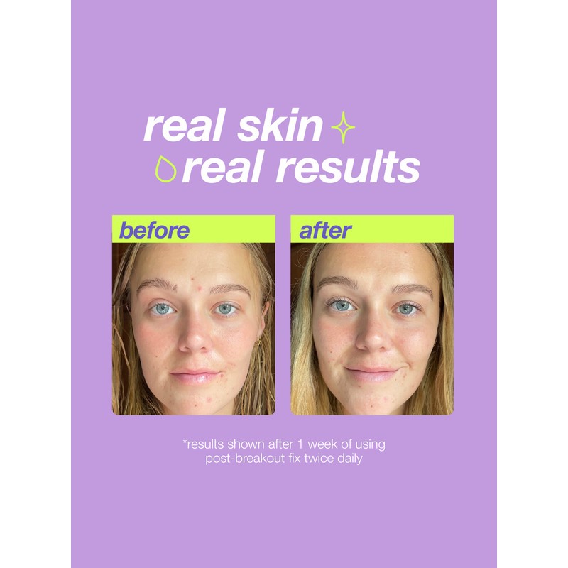 Dermalogica Full Size Post Breakout Fix 15ml