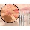 Pyrgasm Blackhead Acne Removal Tweezers Sebum Extrusion Removal Tweezers / 피르가즘 블랙 헤드 여드름 제거 집게 피지 압출 제거 핀셋