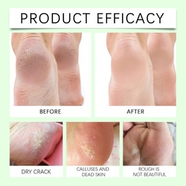 Urea Foot Cream - Ultra Moisturizing 40% Urea Foot Cream Plus 2% Salicylic Acid - Callus and Dead Skin Remover, Deeply Moisturize, Repair Dry, Cracked, Rough Skin of Heel, Elbow and Knee(120g)