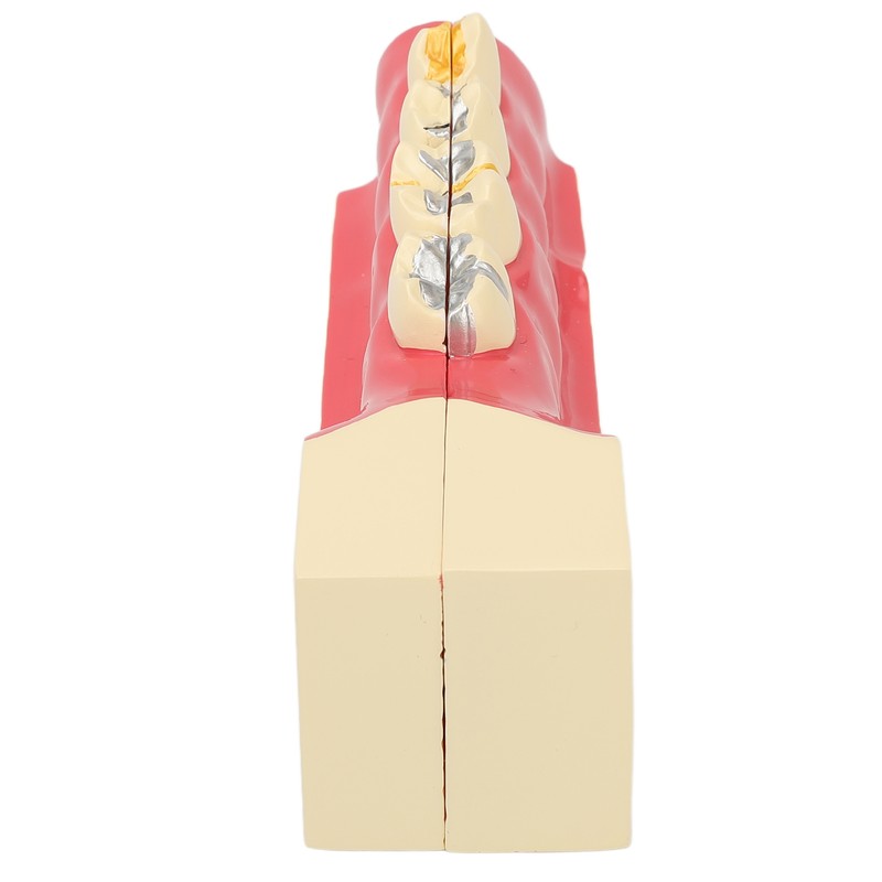 Right Lower Posterior Tooth Model 2X Magnification Detachable Resin Tooth