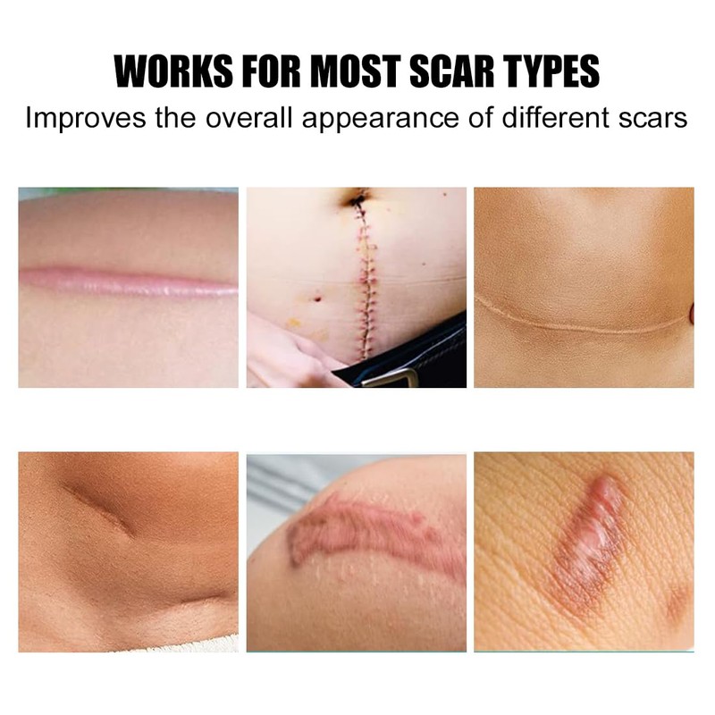 Silicone Scar Sheets 1.6" x 6" Silicone Scar Tape for
