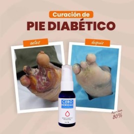 Gel Cicatrizante Pie Díabetico Úlcera Varicosa Regenerador