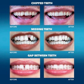 Imako Tooth Tinted Plastic - Natural Color - Temporary Tooth - Made in USA