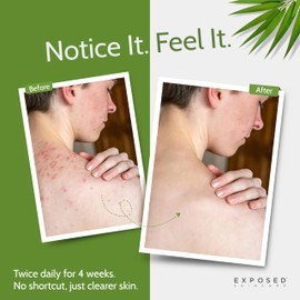 Exposed Skin Care Body Wash - Back and Body Acne Wash with Salicylic Acid and Tea Tree Oil – Exfoliating Bacne Treatment for Clearer, Healthier Skin – Body Cleanser for All Skin Types (12 fl oz)