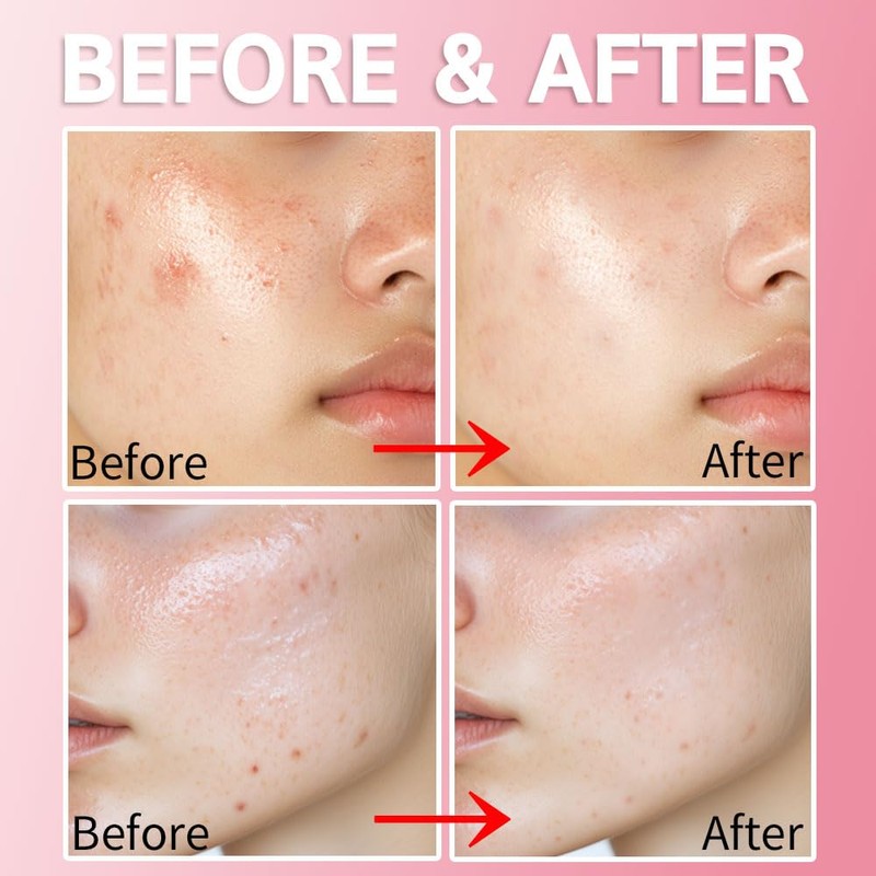 Purederm Blemish Spot Treatment Gel with Salicylic Acid 2%, Soothing