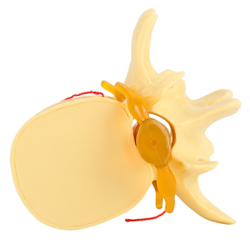 1:1.5 Anatomical Medical Human Spine Lumbar Disc Herniation Demonstration Model