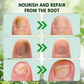 2PCS Ginger Nail Treatment – Nail Growth Serum & Cuticle Care Oil, 7-Day Nail Repair & Strengthener, Nourishing Nail Nutrient Oil for Healthier, Stronger Nails 2 Fl Oz (Pack of 2)