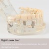 2PCS Teeth Model, Transparent Dental Implantation Disease Tooth Model, Dental
