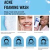 Acne Foaming Wash Acne Foam Wash Cleansing Foam Facial Cleansing
