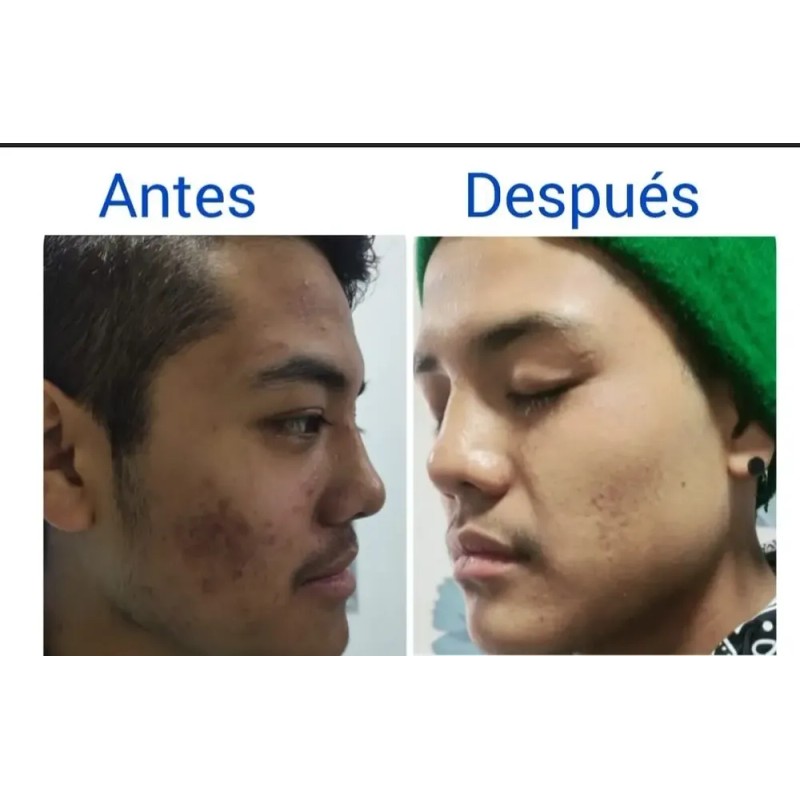 Crema Aclarante De Cara Para Manchas Y Melasma De Laboratori