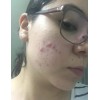 Crema Despigmentante De Paño Melasma Acne
