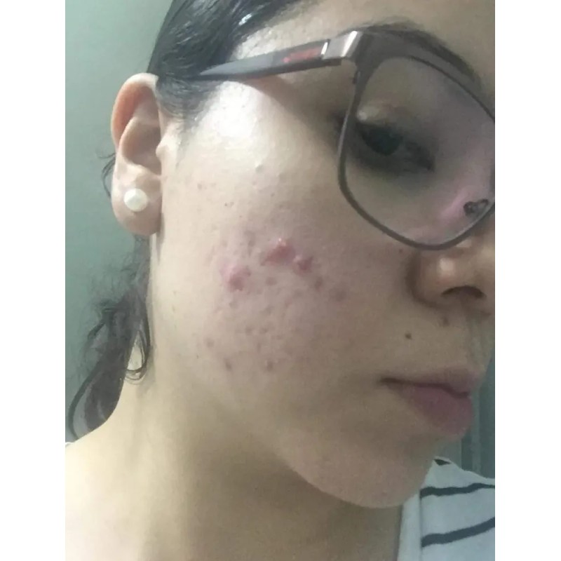 Crema Despigmentante De Paño Melasma Acne