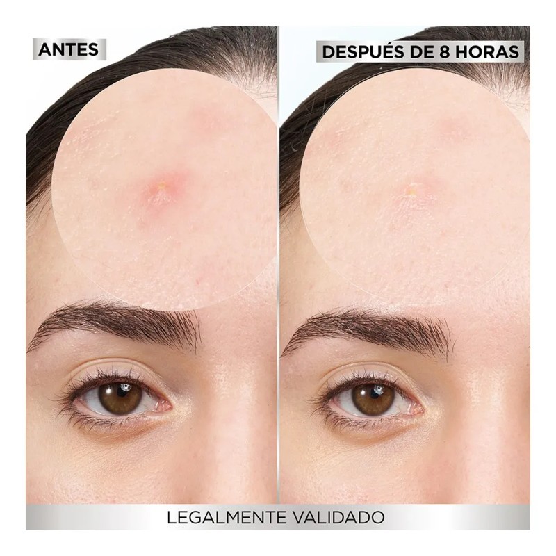 Parche Parches Acné Invisibles Pimple