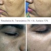 Dermaceutic Kit Booster Azelaico 10% + Tranexámico 5% Melasma Manchas